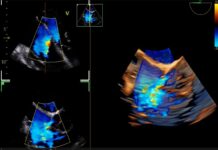 Transesophageal echocardiography