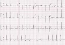 ECG